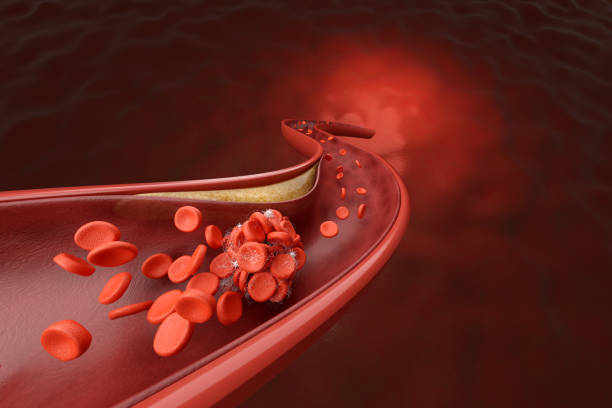 Cross-section illustration of an artery narrowed by yellow atherosclerotic plaque and obstructed by a blood clot.