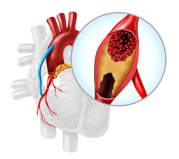 Medical diagram of a human heart showing a blocked coronary artery with plaque buildup and a blue bypass graft connecting the aorta to a vessel below the blockage.