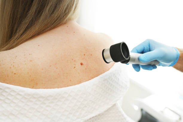 A dermatologist using a dermatoscope to examine moles on a patient's upper back during a skin cancer screening.